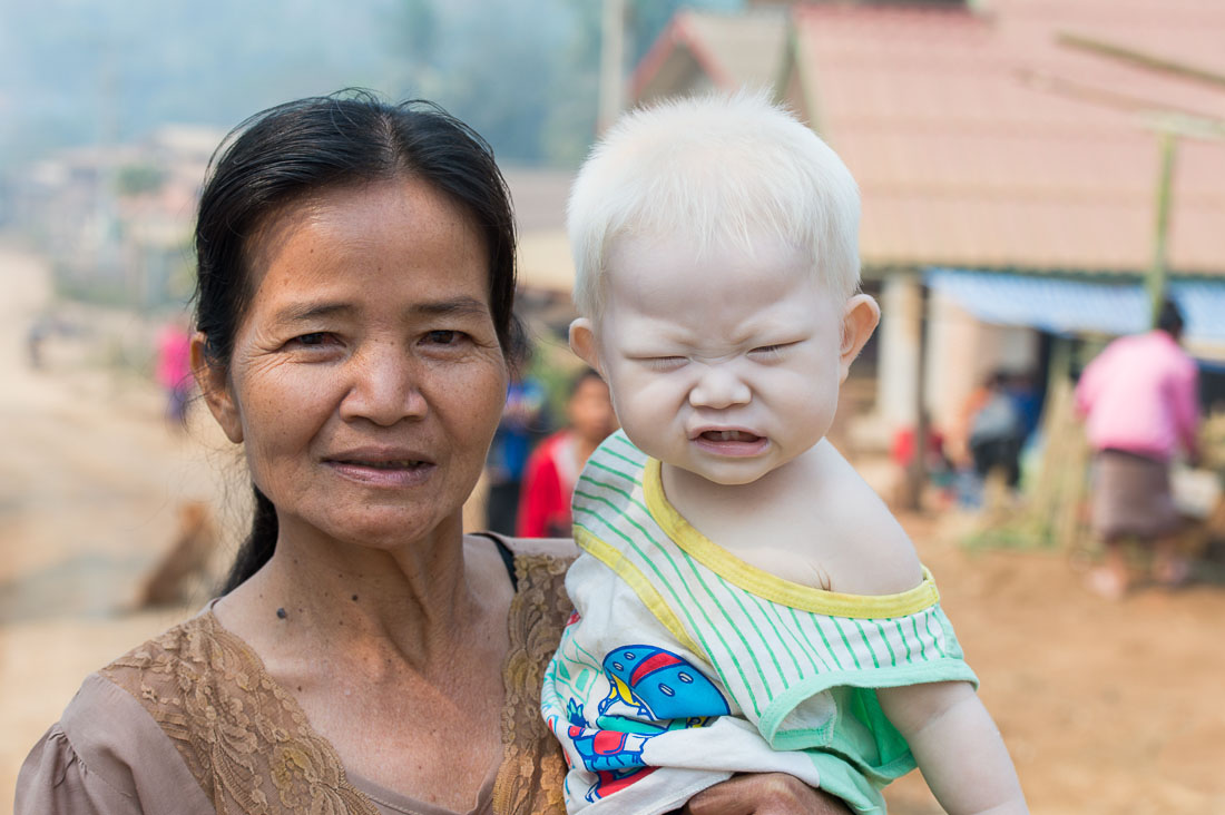 A child from the Sayabouly province effected by albinism, with his grandmother. Lao PDR, Indochina, South East Asia.