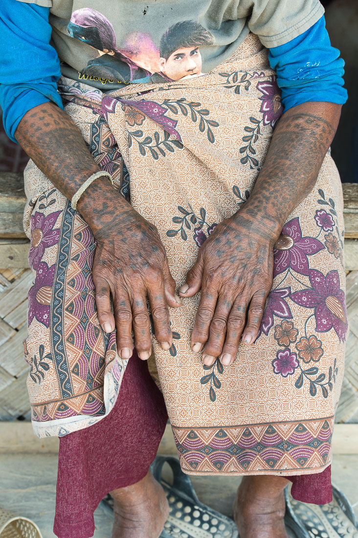 A very old woman from the Khamu people ethnic minority, showing her arms fully covered by traditional tribal tattoos. Meung Ngeun district. Lao PDR, Indochina, South East Asia